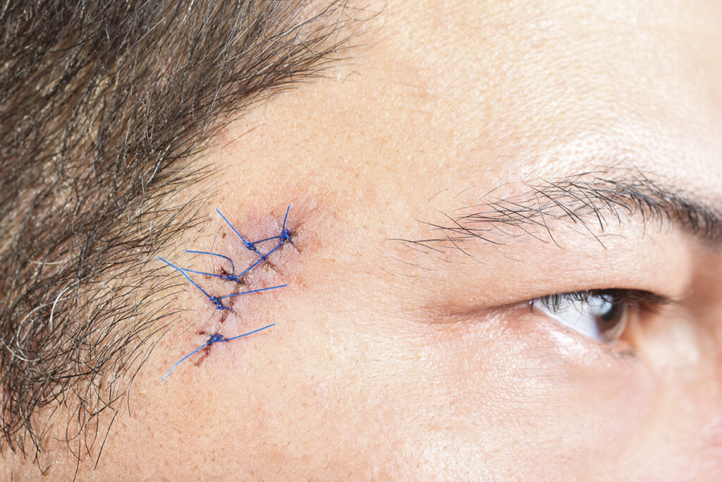 Close up photo of surgical sutures from a facial procedure