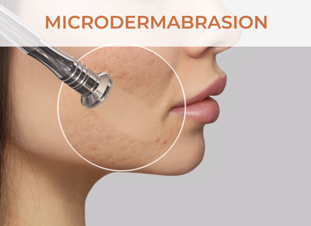 Microdermabrasion Services - Click to learn more