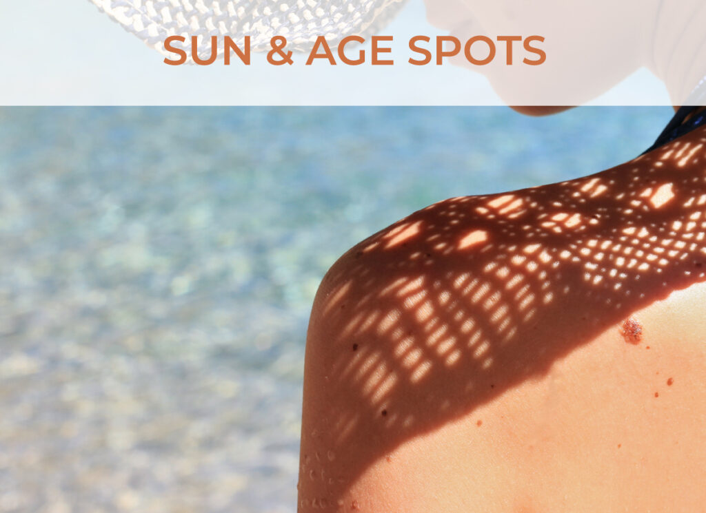 Sun & Age Spots Services - Click to learn more