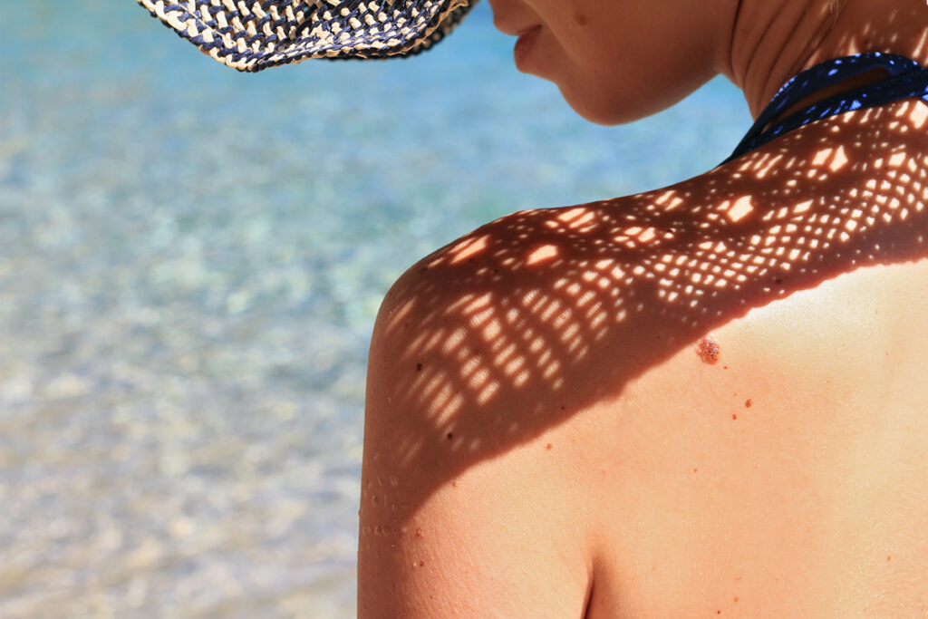 Sun and Age Spots - photo of a woman's shoulder outdoors wearing a hat